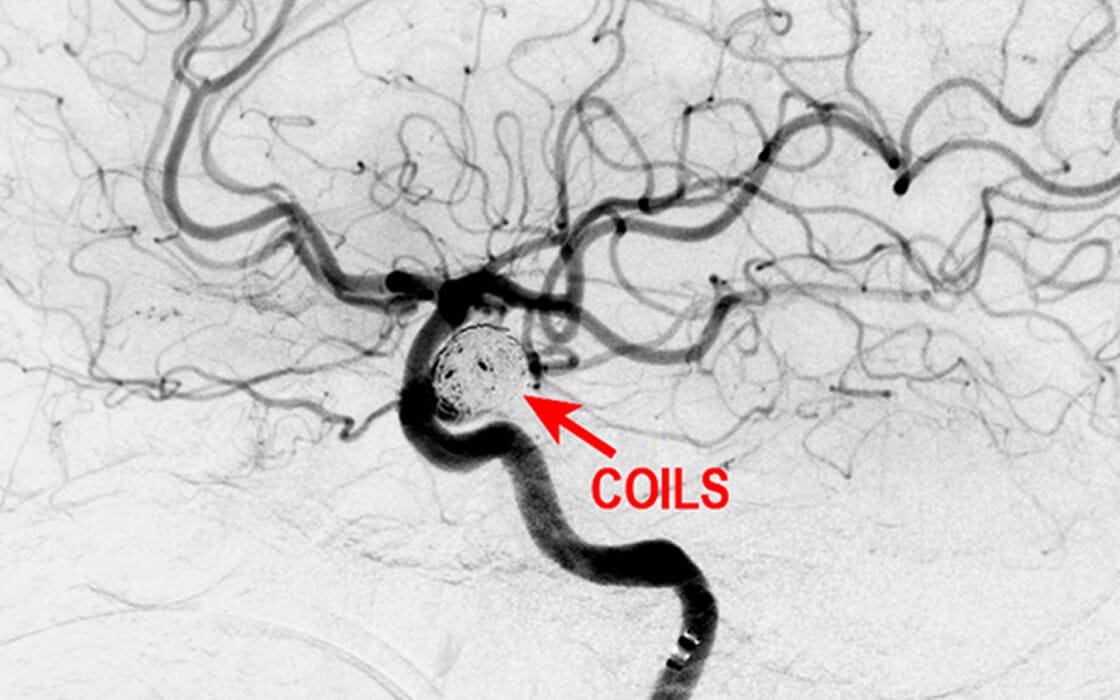 Aneurysm Coiling