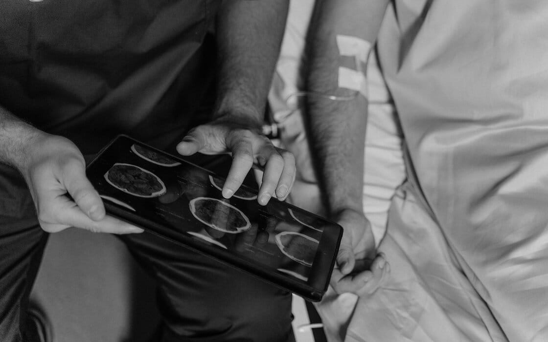 AVM Embolization