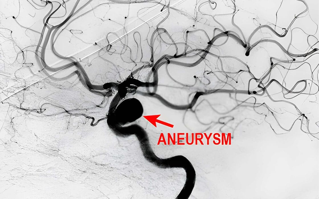Brain Aneurysm Treatment