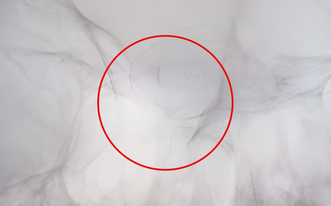 Flow Diverter Procedures