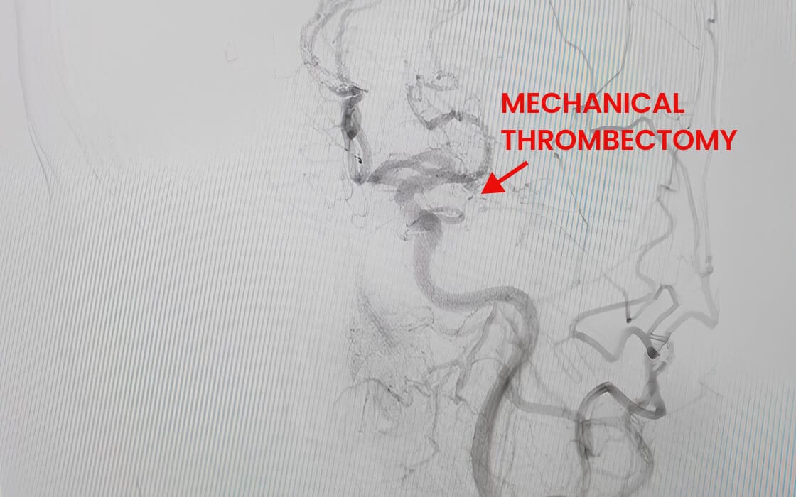 Mechanical Thrombectomy