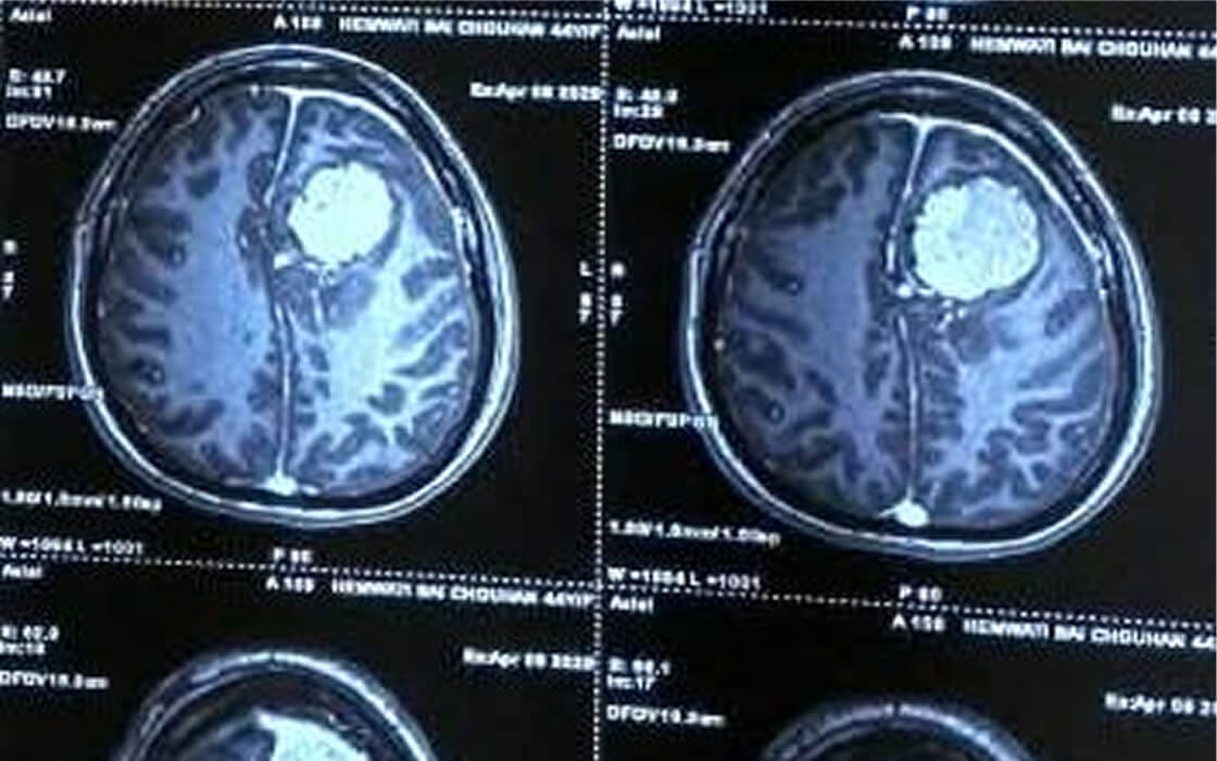 Brain Tumor Surgery