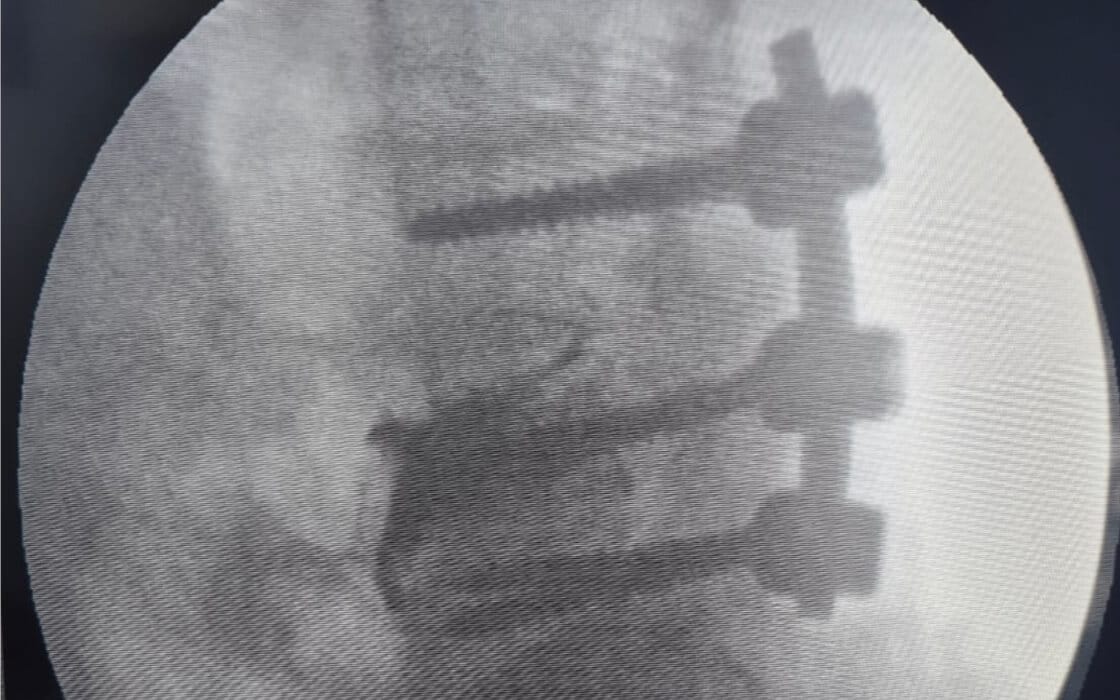 Spine Surgery